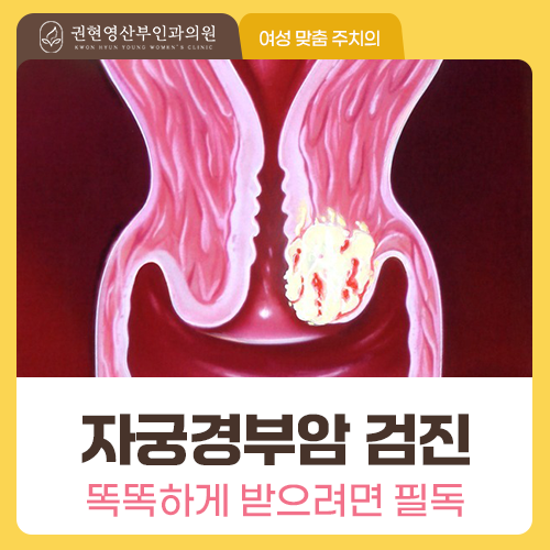 자궁경부암, 증상이 없어도 검사가 필요한가요?