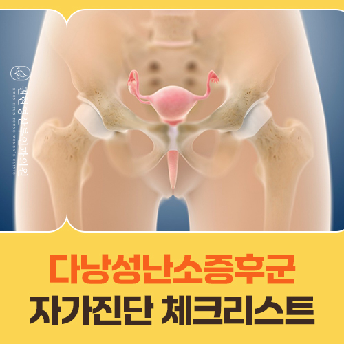 다낭성난소증후군, 어떤 신호가 보이면 의심해야 할까요?